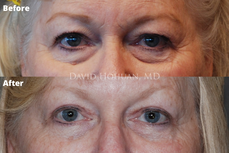 Blepharoplasty Dr. Hohuan Yuma AZ