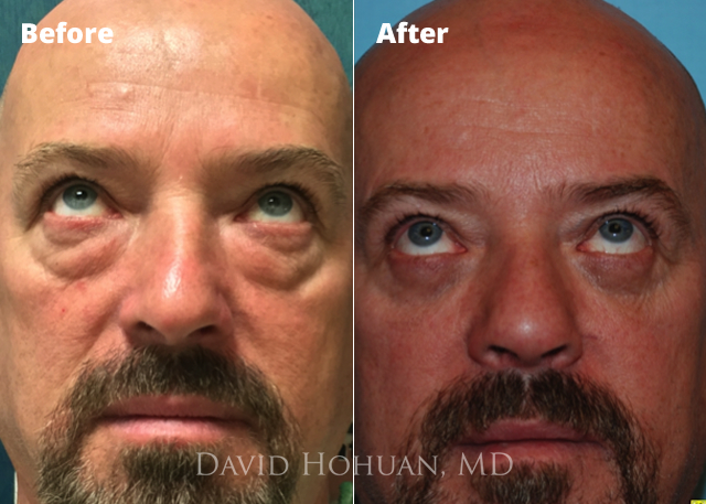 Transconjunctival blepharoplasty deals