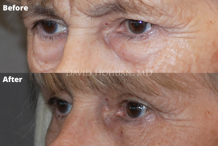 Blepharoplasty Dr. Hohuan Yuma AZ