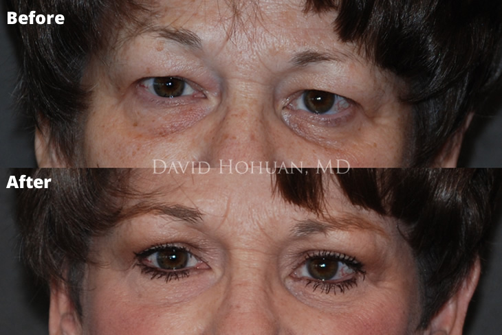 Blepharoplasty Dr. Hohuan Yuma AZ