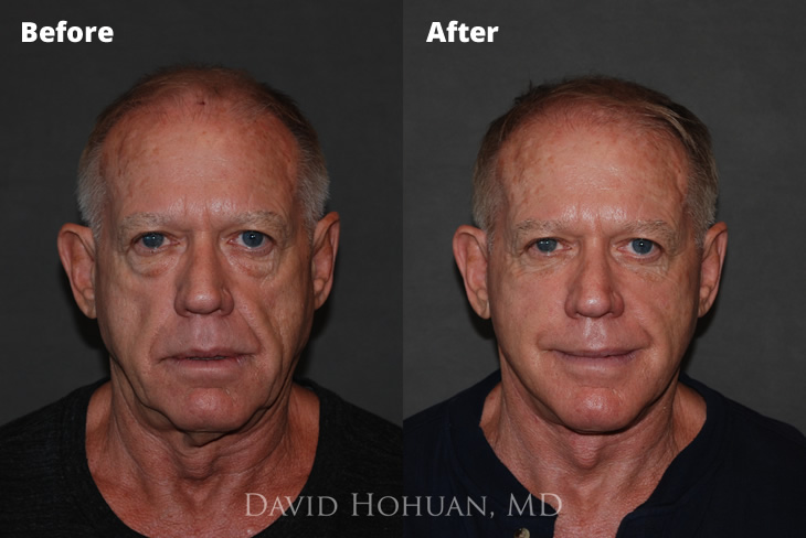 Facelift and Blepharoplasty by Dr. David Hohuan