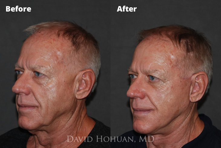 Male Face and Eyelid Lift