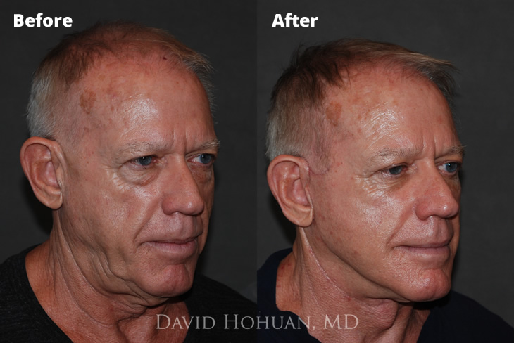 Oblique Face and Eyelid Surgery
