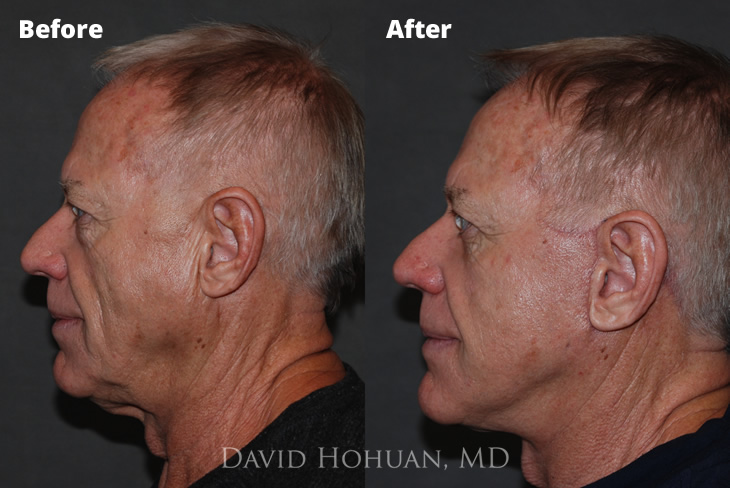 Male Side View Facelift