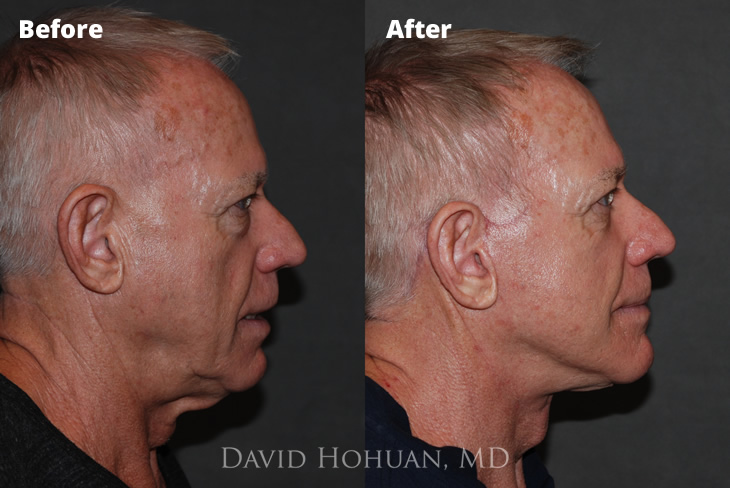 Facelift and Eyelid Lift