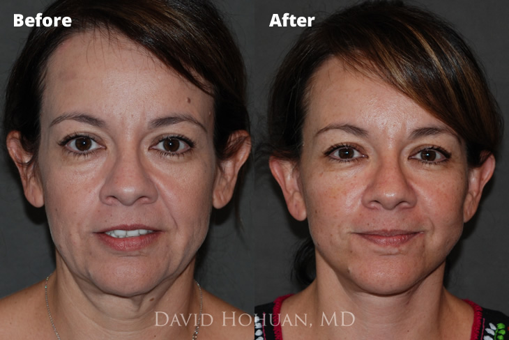 Surgical Facelift and Necklift Yuma, AZ, David Hohuan, MD