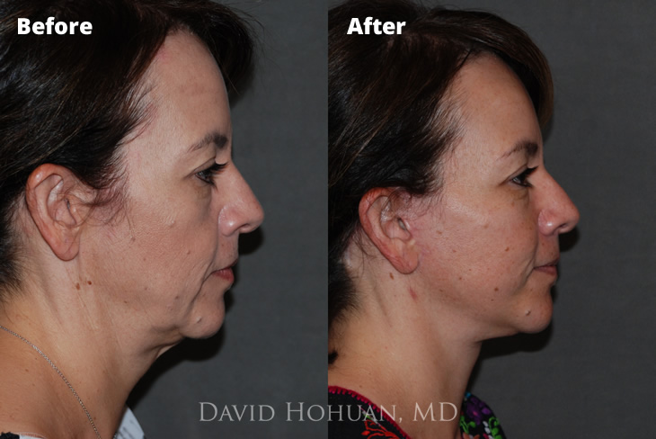 Lower Facelift Before and After