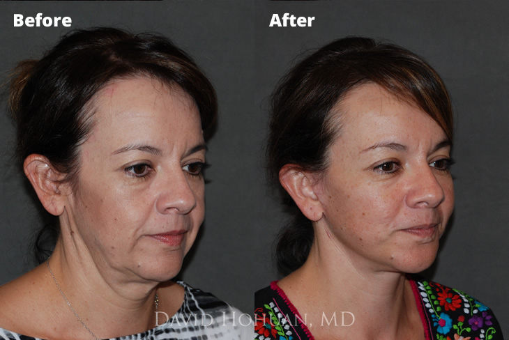 Lower Facelift Before and After