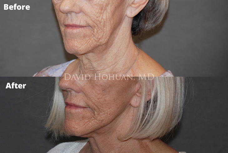 Facelift and Necklift Yuma AZ