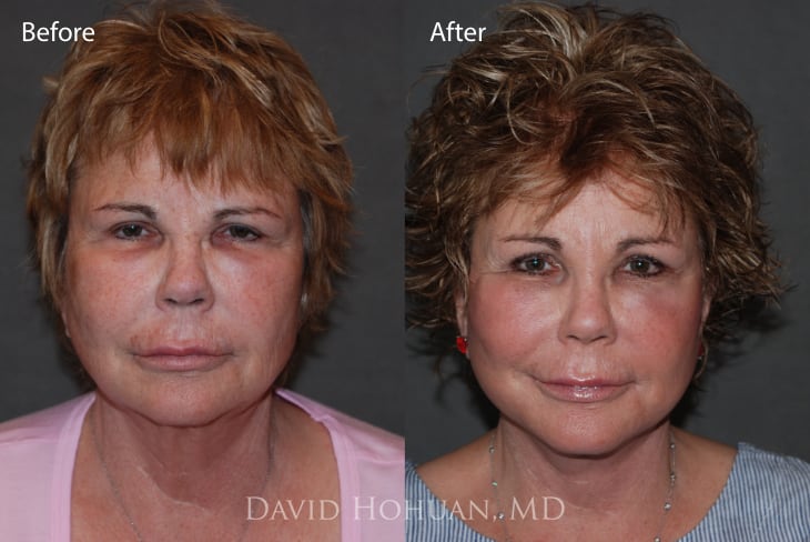 Face and Neck Lift 