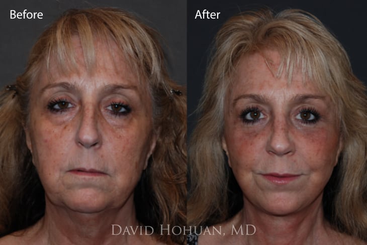 Deep Plan Face and Neck Lift 