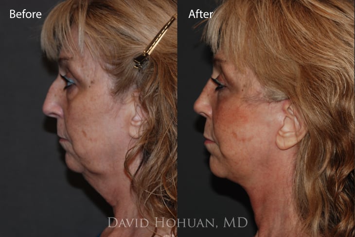 Deep Plan Face and Neck Lift 