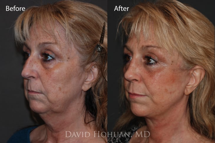 Deep Plan Face and Neck Lift