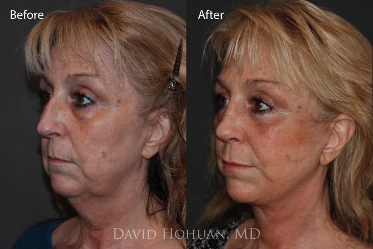 Deep Neck Lift Scottsdale  Neck Lift Specialist in Scottsdale