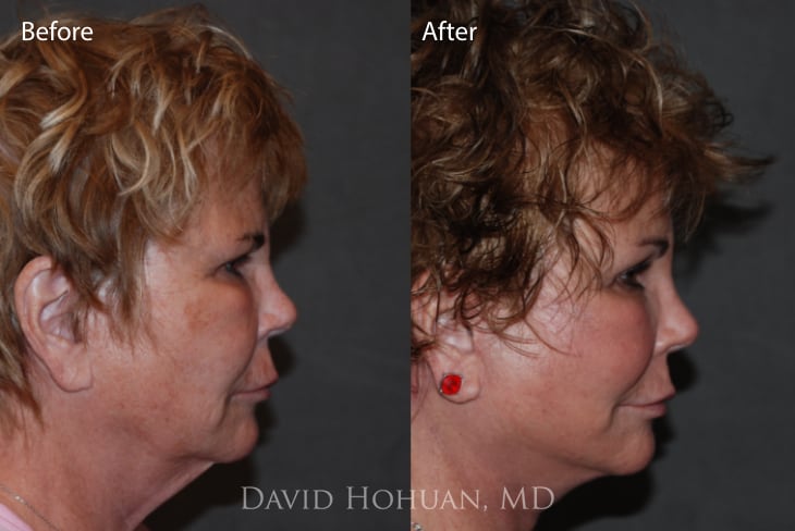 Face and Neck Lift 