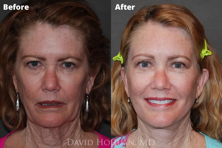 Browlift, Face and Neck Lift 