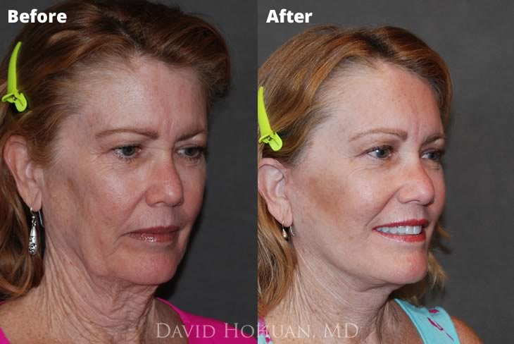 Browlift, Face and Neck Lift 