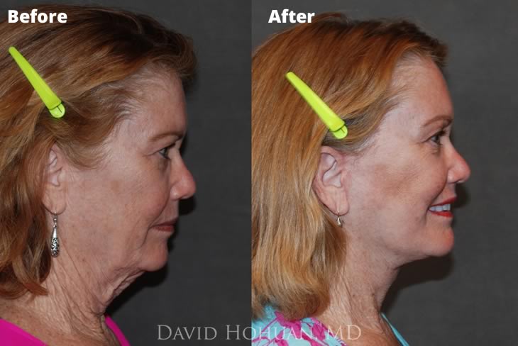 Browlift, Face and Neck Lift 