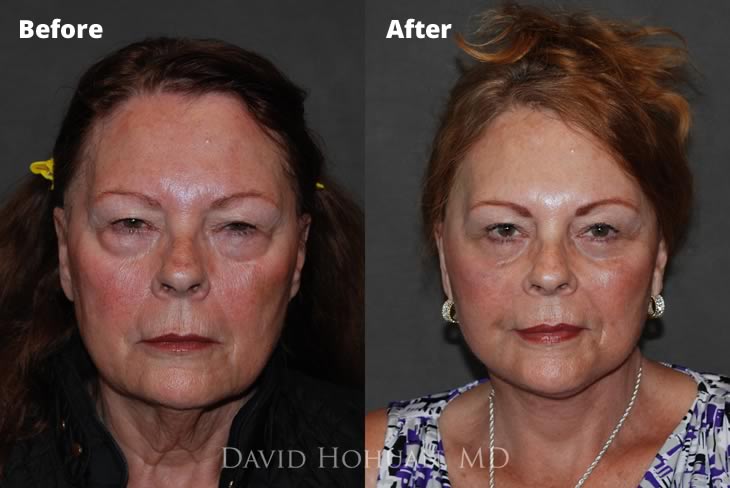 Facelift Front View by Dr. David Hohuan
