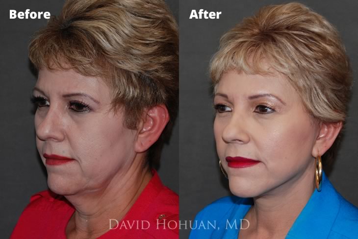 Facelift and Browlift