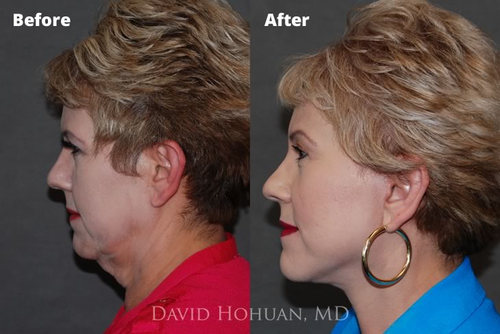 Oblique Face and Browlift Surgery