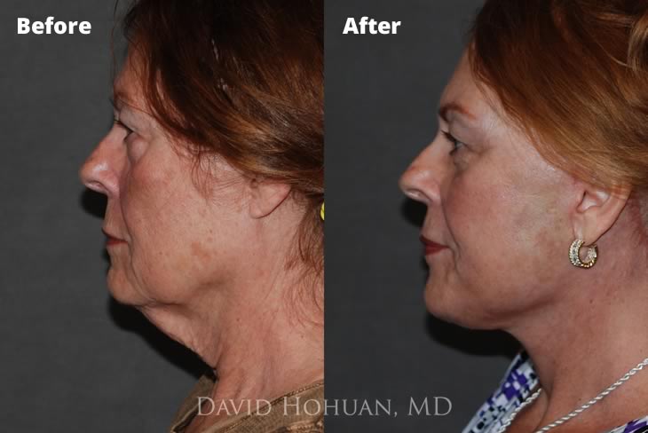 Side View Facelift by Dr. David Hohuan