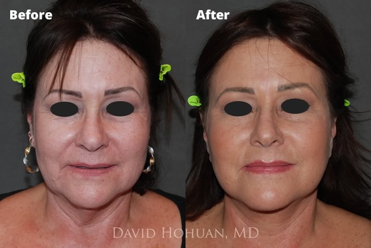 Face and Browlift Lift
