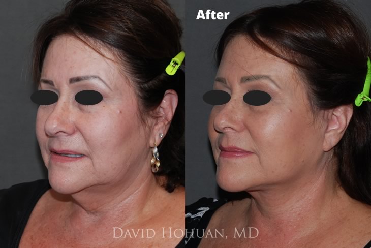 Oblique Face and Browlift Surgery