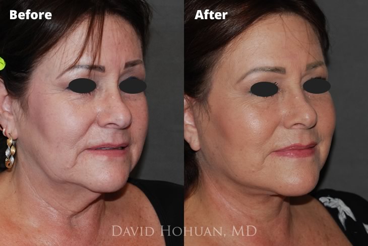 Oblique Face and Browlift Surgery