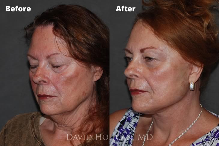 Oblique View Facelift Yuma AZ