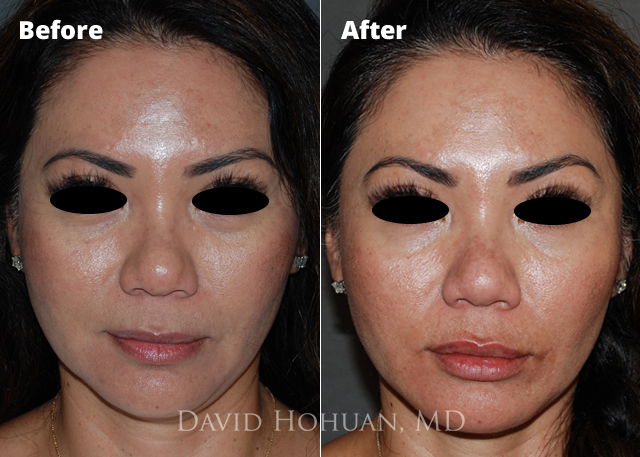 Facial Filler and Lip Augmentation