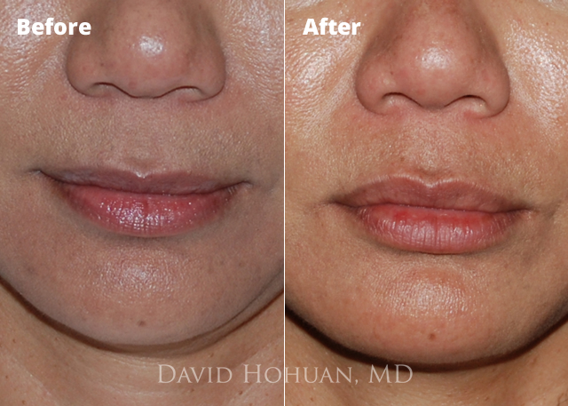 Lip Augmentation Yuma, AZ