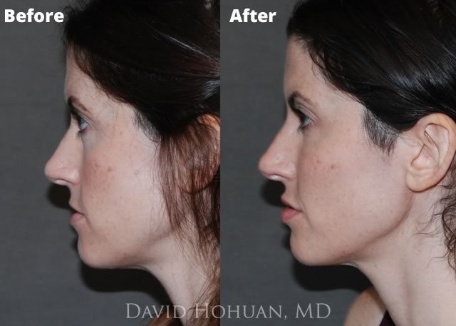 Facial Fillers and Botox