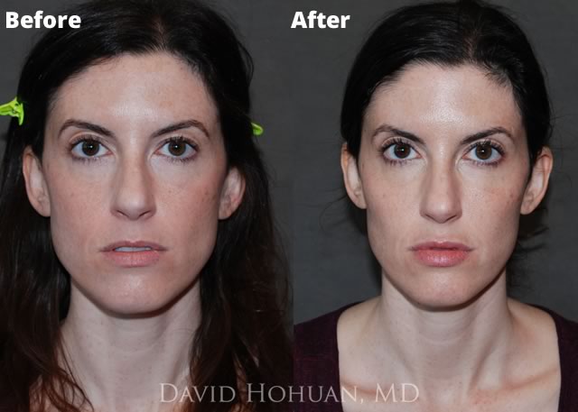 Facial Fillers and Botox