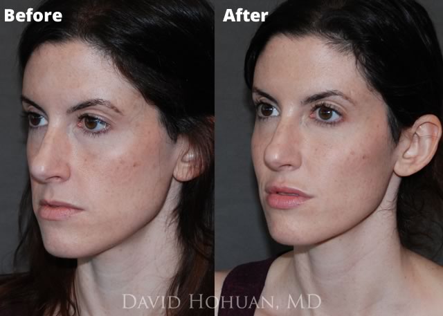 Botox Nose Slimming PHX