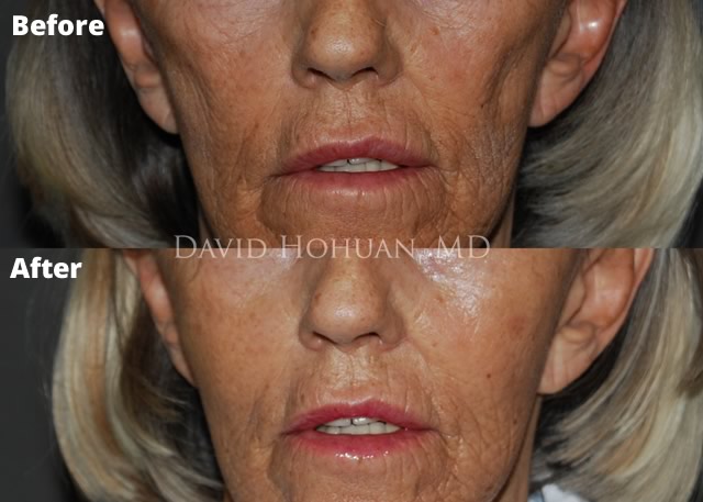 Radiesse Facial Filler Before and After