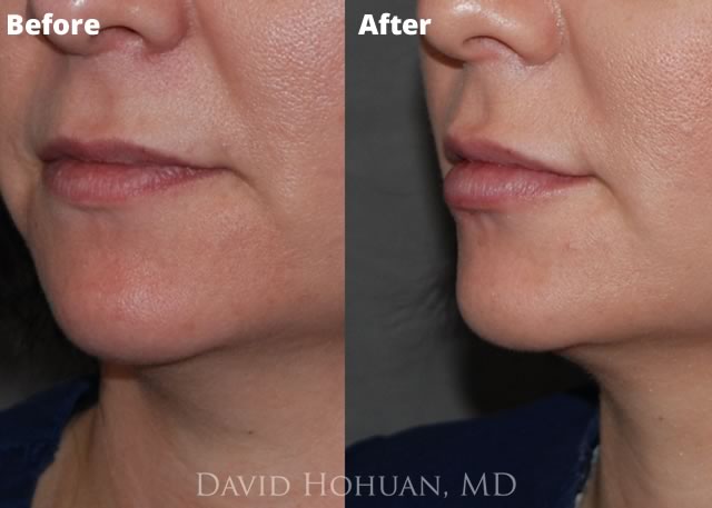 Lip Augmentation Yuma AZ