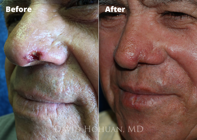 Basal Cell Carcinoma Nose Before After Pictures