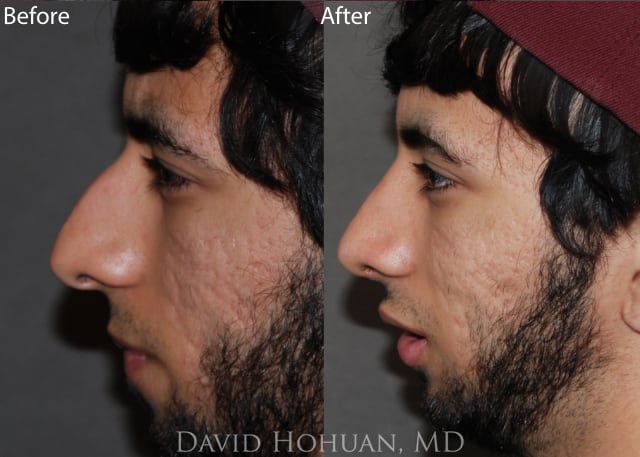 Rhinoplasty Before and After