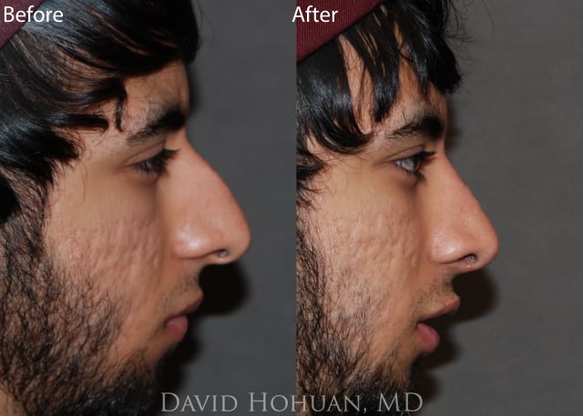 Rhinoplasty Before and After