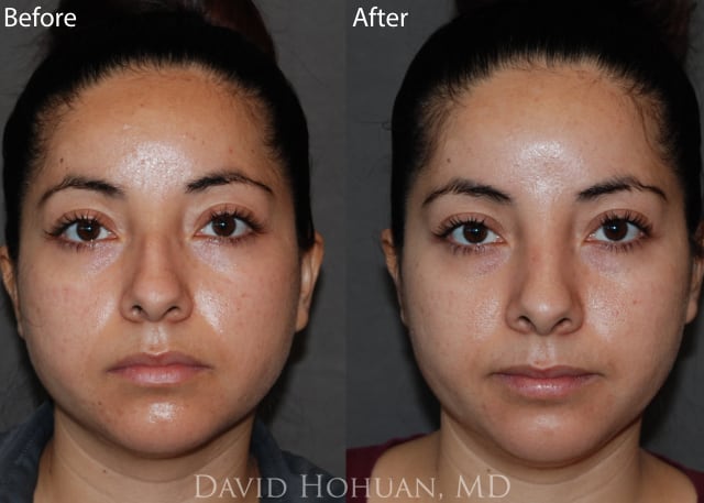 Rhinoplasty Before and After