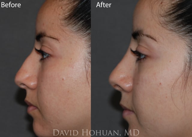 Rhinoplasty Before and After