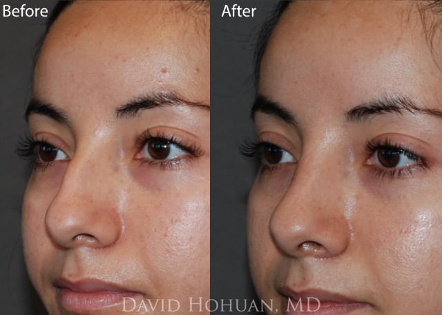 Rhinoplasty Before and After