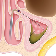 Graphic Step 1. A balloon catheter is inserted into the inflamed sinus.