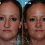 Diagnosis: Nasal Trauma, Droopy Tip, Crooked Nose, Dorsal Hump
Procedure: Rhinoplasty
Technique: Open Nasal Septal Reconstruction, Tip Refinement using Control Columellar Strut and Tip Suture Techniques, Conservative Hump Reduction using Ultrasonic Bone Aspirator.