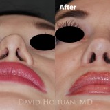 Diagnosis: Previous failed open rhinoplasty, Open Roof Deformity, Collapsed Upper Lateral Cartilage, Tip Deformity, Alar Rim Retraction, External Nasal Valve Collapse
Procedure: Revision Open Structure Septorhinoplasty, Rib Cartilage Harvest, Deep Temporalis Fascia Harvest
Techniques: Revision spreader grafts (asymmetric), Left Low-to-High Osteotomy, TIG columella reconstruction, Lateral Crural Strut Grafts, Tip suture-plasty, Temporalis Fascia Apron 