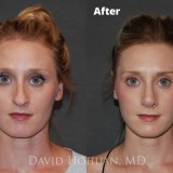 Diagnosis: Severe Nasal Obstruction, Aesthetic Deformity
Procedure: Open Structure Septorhinoplasty
Details: Precise Component Hump Reduction, Spreader Grafts, Tip Rhinoplasty using TIG, LCSS, DCS, TPS, and minimal cephalic reduction, crushed cartilage, alar rim grafts.