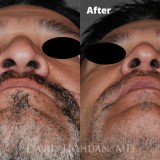 Diagnosis: Severe Nasal Obstruction, Ptosis (Droopy) Nasal Tip
Procedure: Open Structure Rhinoplasty
Details: Extended Spreader Grafts, Septal Extension Graft, Tip Suture Technique