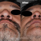 Diagnosis: Severe Nasal Obstruction, Ptosis (Droopy) Nasal Tip
Procedure: Open Structure Rhinoplasty
Details: Extended Spreader Grafts, Septal Extension Graft, Tip Suture Technique