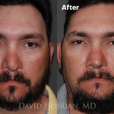 Diagnosis: Bilateral Cleft Nasal Deformity, Previous Rhinoplasty with Resultant Major Tip Deformity, Collapsed Tip Cartilage Left Greater Than Right, Severe Tip Asymmetry, Nasal Valve Collapse, Severe Septal Deformity.
Procedure: Revision Open Septorhinoplasty Using Rib Cartilage
Techniques: Rib cartilage harvest, Extended spreader grafts, triangular septal extension graft, alar rim grafts, onlay tip graft (cartilage), onlay tip graft (perichondrium), Lateral crural spanning sutures, medial crural fixation sutures.
Shown: Result at 18 months